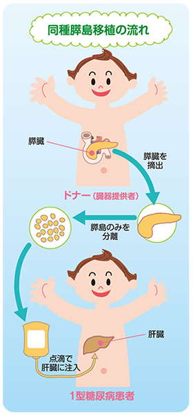 同種膵島移植の流れ